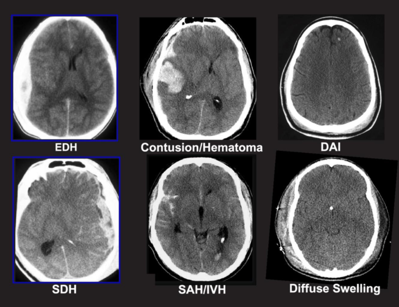 Hominick Hematoma